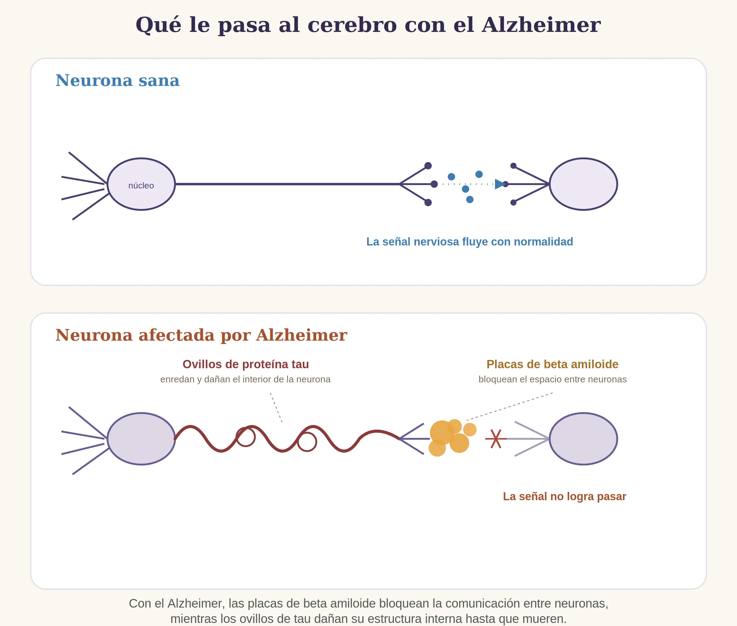 Cerebro con placas y ovillos caracteristicos del alzheimer